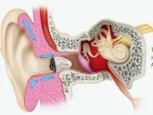  ??  ?? The Invisible In Canal (IIC) is virtually undetectab­le. As shown in this image.