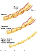  ??  ?? (See the special neuropathy severity examinatio­n at the end of this article)