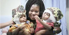  ?? | EPA ?? TWIN sisters Ervina and Prefina, who were joined from the back of the head from birth, with their mother Ermine, following their surgery at the Bambino Gesu hospital in Rome this week.