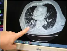  ??  ?? Précision. Ce scanner indique les lésions aux bronches d’un patient soigné dans l’unité Covid-19 des soins intensifs du service de pneumologi­e de l’hôpital Larrey, à Toulouse, le 28 septembre.