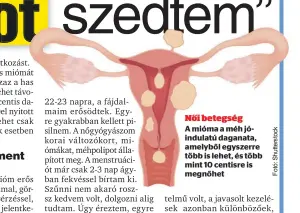  ??  ?? Női betegség
A mióma a méh jóindulatú daganata, amelyből egyszerre több is lehet, és több mint 10 centisre is megnőhet