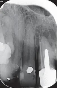  ?? Dental Law Partnershi­p ?? This X-ray shows an infection in Jayne’s upper right central incisor