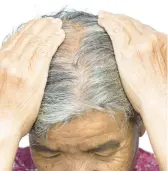  ?? DREAMSTIME ?? Menopause can bring on hair loss.