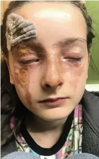  ?? Kennedy News and Media ?? ●● The incident left youngster Kadie Law with severe facial injuries