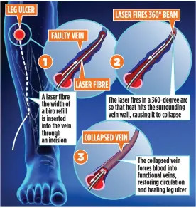  ??  ?? STEP FORWARD: How the laser helps to heal a leg ulcer. Below: Rod Stacey