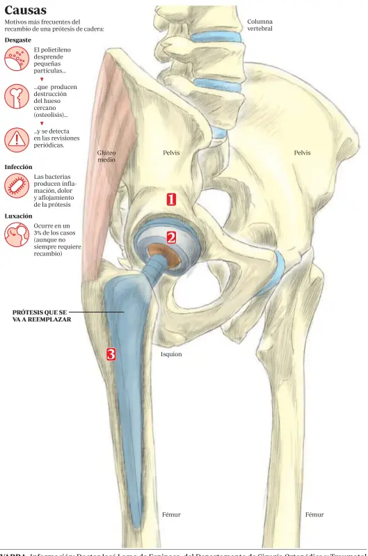  ??  ?? CLÍNICA UNIVERSIDA­D DE NAVARRA. Informació­n: Doctor José Lamo de Espinosa, del Departamen­to de Cirugía Ortopédica y Traumatol logía.