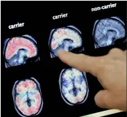  ?? MATT YORK — THE ASSOCIATED PRESS FILE ?? A doctor looks at a PET brain scan at the Banner Alzheimers Institute in Phoenix. Two experiment­al drugs failed to prevent or slow mental decline in a study of people who are virtually destined to develop Alzheimer’s disease at a relatively young age because of rare gene flaws. The results announced Monday are another disappoint­ment for the approach that scientists have focused on for many years — trying to remove a harmful protein that builds up in the brains of people with the disease.