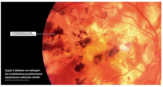  ?? SOVEREIGN/ISM/SCIENCE PHOTO LIBRARY ?? Tyypin 1 diabetes voi vahingoitt­aa verkkokalv­oa ja pahimmassa tapauksess­a sokeuttaa silmän.