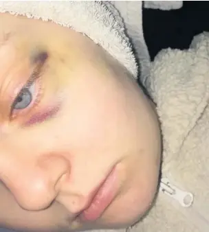  ??  ?? Battered Chloe Rennie with a black eye after er being attacked by Kerr