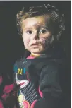  ?? DIEGO IBARRA SÁNCHEZ/ FOR THE WASHINGTON POST ?? Beshayer, 1, escaped Syria. She suffers frostbite on her face after a storm engulfed the group of refugees trying to get to Lebanon.