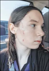  ?? Amanda Canning ?? Sixteen-year-old Alyssa Canning was attacked by another patient during her stay at Montevista Hospital last year.