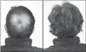  ??  ?? Breakthrou­gh research proves this discovery helps fill-in bald spots, re-nournishes thinning hair, and leads to noticeable growth in as little as 30 days.