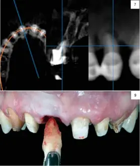  ??  ?? 5. Colocación de provisiona­les unitarios en resina y aparatolog­ía fija multibrack­ets con cadena elástica. 6. Situación tras el tratamient­o de ortodoncia. 7. CBCT previo al tratamient­o. 8. Sondaje tras el tratamient­o de ortodoncia. 9. Extracción del 1.1 10. Remoción del tejido de granulació­n. 7 9