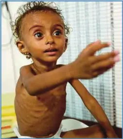  ??  ?? BAYI perempuan, Ferial Elias, 2, yang mengalami kekurangan zat menerima rawatan di Hospital l-Thawra, Hodeidah, Yaman, bulan lalu. - Reuters
