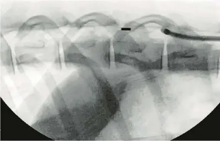  ?? BIONAUT LABS ?? An X-ray shows a Bionaut Labs device that was injected into a sheep. The robot can deliver drugs to a precise location.