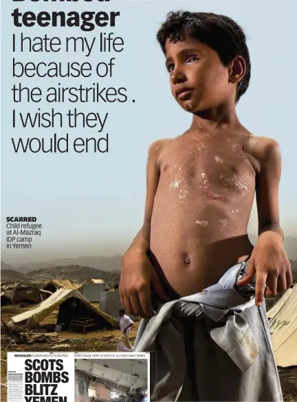  ??  ?? SCARRED Child refugee at Al-Mazraq IDP camp in Yemen