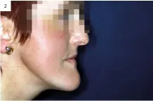  ?? ?? 2
Figuras 1 y 2. Estética facial de la paciente con las prótesis colocadas. Aun con ellas, la clase III esquelétic­a es evidente.