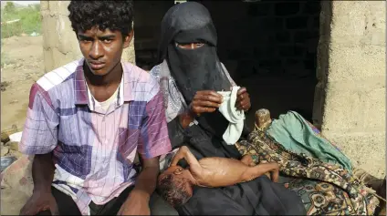  ??  ?? In this Aug. 25, photo, severely malnourish­ed infant the village of al-Mashradah, Aslam, Hajjah, Yemen. AP PHOTO/HAMMADI ISSA