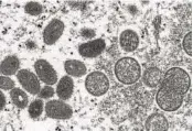  ?? CDC VIA AP ?? A microscope image shows mature, oval-shaped monkeypox virions (left) and spherical immature virions (right) obtained from a sample of human skin associated with the 2003 prairie dog outbreak.