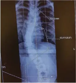  ?? ILLUSTRASJ­ONSBILDE ?? SKEIVHET: Slik ser ryggsøylen til en med tilstanden skoliose ut. Her er ryggraden 53 grader skeiv.