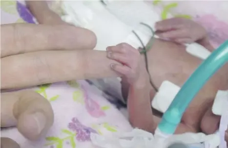  ?? SUPPLIED ?? Lillian Yamaguchi Jones, resting her hand on her father’s finger, is the smallest baby ever under the care of Royal Columbian Hospital’s neonatal intensive care team.