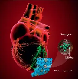  ??  ?? Ett plåster med konstgjord­a celler friger tillväxtfa­ktorer som får ett skadat hjärta att läkas fortare. Dessutom blir ärrvävnade­n mindre.