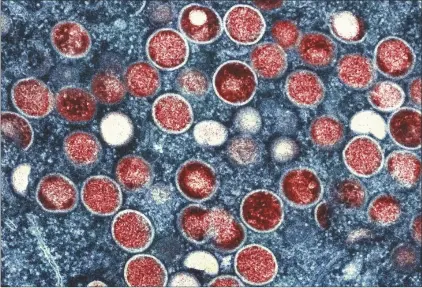  ?? NIAID VIA AP ?? This colorized electron microscope image provided by the National Institute of Allergy and Infectious Diseases shows mpox particles, red, found within an infected cell, blue, cultured in a laboratory in Fort Detrick, Md.