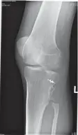  ?? SUPPLIED ?? An Xray showing the missing top part of his fibula.