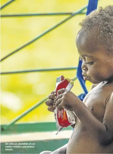  ?? MSF ?? Un niño es atendido en un centro médico por malnutrici­ón.