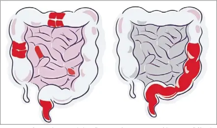  ?? — Images: Prof Ida normiha HILMI ?? Ibd comprises of two conditions: Cd, which is inflammati­on of one or more parts of the intestines (left), and uc, which is inflammati­on of the large intestine.
