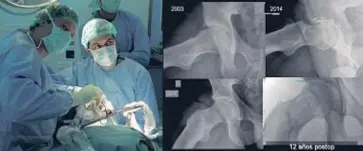  ??  ?? Izquierda: Dr. Ribas y Dr. Càrdenas en acción durante un abordaje mini-invasivo por artroscopi­a. Si bien son los menos, en algunos casos de grandes deformidad­es en el choque femoroacet­abular el abordaje mini-invasivo, también conocido como “el gran...