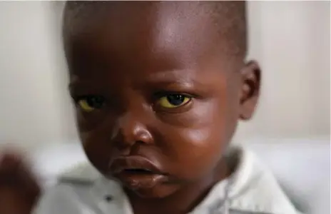  ?? JEROME DELAY PHOTOS/THE ASSOCIATED PRESS ?? Three-year-old Jonathan Kangu’s eyes are a symptom of yellow fever, but a lack of diagnostic tools meant doctors couldn’t confirm if he had the disease.