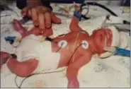  ?? PHOTO COURTESY OF LORNA DAVID ?? Born prematurel­y at just 30 weeks, Matthew David’s body had not fully developed and was in renal failure within his first few days of life.