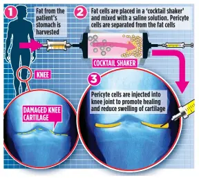  ??  ?? JOINT EFFORT: How an arthritic knee is soothed and healed by the fat cells