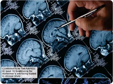  ?? ?? COMBINATIO­N THERAPIES: At least 16 treatments for Alzheimer’s are being tested in clinical trials