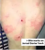  ??  ?? > Bite marks on Jarrad Davies’ back