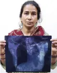 ??  ?? NEW DELHI: Indian patient Seema Malin, 38, and who has suffered from asthma for four years, poses with an x-ray of her lungs at a hospital. — AFP photos