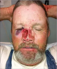  ?? Photograph submitted ?? Tim Tillman after being kicked in the face by an 800-pound bull waiting in the emergency room before the cut on his nose was stitched.