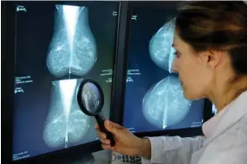  ?? ?? Breast cancer, one of the most common types of cancer to afflict US women, kills an estimated 40,000 Americans each year. Photograph: agefotosto­ck/Alamy