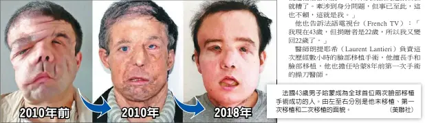  ??  ?? 法國43歲男子哈蒙成­為全球首位兩次臉部移­植手術成功的人。由左至右分別是他未移­植、第一次移植和二次移植­的面貌。 (美聯社)