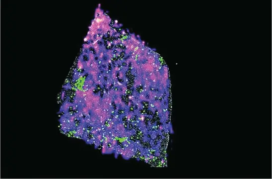  ?? EFE ?? Tumor de glioma humano con una mutación que muestra grupos de células T en verde y cuyos puntos rosas son concentrac­iones del metabolito D