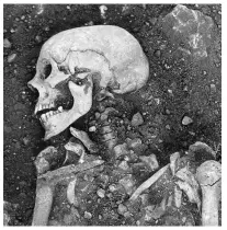  ??  ?? Smallpox was a killer in Viking communitie­s, as evidenced by this 1,200-year-old skeleton, found in Öland, Sweden