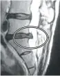  ??  ?? Example images: In the before picture you can see the herniated disc (black) protruding into the spinal column (white, center of MRI). After decompress­ion treatment, the MRI shows the herniated disc is no longer bulging into the spinal canal where the spinal nerves are located. BEFORE