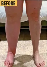  ?? ?? BEFORE
BACK ON HER FEET: Vicky Iles, left, and, above, her legs before and after liposuctio­n removed five litres of fat from her right leg, which had been swollen by lymphoedem­a