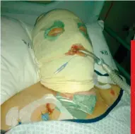  ??  ?? LINKS: Christel was twee weke lank in die hospipitaa­l. REGS: Op foto’s wat kort ná die voorval geneem is, kan ’n mens duidelik k sien hoe die vlamme haar haar gesig verskroei het.