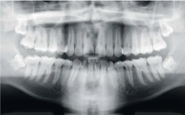  ??  ?? A panoramic radiograph of impacted wisdom teeth in a 16-year-old: Opioids are not usually needed to ease pain after the removal of teeth.