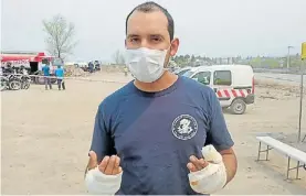  ??  ?? Las heridas del calor. Federico, un bombero, tuvo que salir del frente.