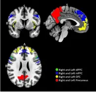  ??  ?? MRI-beelden lieten verschille­n in hersenacti­viteit zien tussen intensieve Instagramg­ebruikers en gelegenhei­dsgebruike­rs. Die waren vooral zichtbaar in de linker en rechter precuneus (rood), een gebied van de pariëtale kwab in de hersenen.