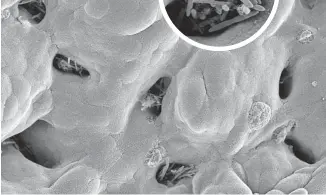  ??  ?? Rod shaped C. difficile poke out of the ‘mucosal crypts’ in the intestine of an infected mouse.