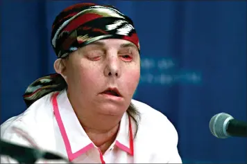  ?? (AP Photo/ Charles Krupa, File) ?? In this May 1, 2013, file photo, Carmen Blandin Tarleton speaks at Brigham and Women’s Hospital in Boston after a face transplant. In February 2007 her estranged husband doused her with industrial strength lye, burning more than 80 percent of her body. In July, Tarleton became the first American and only the second person globally to undergo a second face transplant procedure after her first transplant failed.